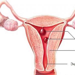 Eco po odstránení polypu endometria