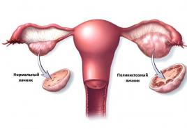 Čo je syndróm polycystických ovárií