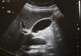 Ultrazvuk jetre i pankreasa Kako napraviti ultrazvuk jetre i gušterače