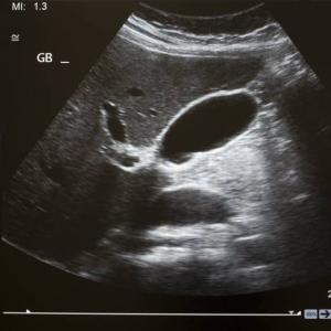 Ultrazvuk pečene a pankreasu Ako urobiť ultrazvuk pečene a pankreasu