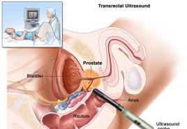 Merkmale des Ultraschalls bei Prostataadenomen Wie man Ultraschall bei Prostataadenomen durchführt