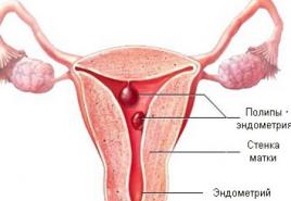 Eco po odstránení polypu endometria