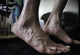 Šta uzrokuje grčeve u nogama